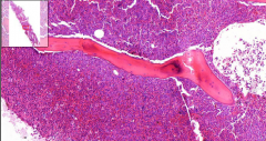 Bone marrow (see bone)
- Hypercellular: Granulocytes and megakaryocytes
- May be fibrosis

Etiology?
Symptoms?