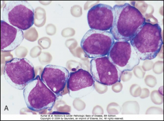 - neoplasm of myelogenous progenitor cells
- AML occurs mostly in adults (accounts for 80% of adult acute leukemias)
- risk factors include exposure to radiation, myeloproliferative syndromes, Down's syndrome, and chemotherapy (alkylating agents...