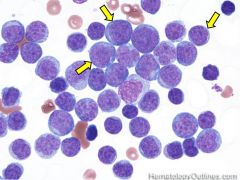 - ALL is a neoplasm of early lymphocytic precursors. Histology reveals a predominance of lymphoblasts
- ALL is the most common malignancy in children under age 15 in the US
- It is the leukemia most responsive to therapy
- Poor prognostic indic...