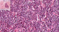 LUNG / BRONCHIOLI
- Big purple lesion in the middle of the slide
- Small lymphocyte like cells, sometimes "oat" elongated
- Mitotic activity (darker) in clusters of hyperchromatic cells

Etiology?
Complications?