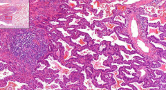 LUNG
- High, columnar cells with mucous production
- Growth of tumor spread along alveolar wall (thus its name)

Etiology?