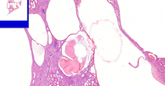 Kidney
- HUGE cysts with low epithelium (pressure atrophy)
- Some kidney remnants in septa among cysts
- Inflammatory infiltrate
- Nephro & arteriosclerosis (increased BP)

Etiology?