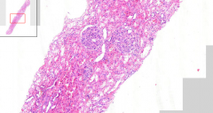 Kidney
- Enlarged glomeruli, filling up Bowman´s capsule
- Feel like glomerular vessels are pushed through it, ooh
- Edematous mesangium
- RBC in tubuli

Etiology?