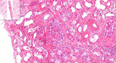 Kidney
- Collapsed capillaries of glomeruli
- Rounded fibroepithelial crescents in bowman´s space
 (pink, homogenous material)

Etiology?
What is a crescent?