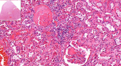 Kidney
- Hyaline nodules in mesangium (glomerulosclerosis)
- Capillaries pushed out to bowman´s space
- Some glomeruli are 100% hyalinized
- Hyaline changes on vessels (arteriosclerosis)

Etiology?
What is sclerosis?
Complications?