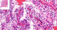 Kidney
- Solid growth pattern of tumor
- Clear cells (cytoplasm w/ glycogen & lipids)
- Low mitotic activity
- 'Sarcomatoid transformation'
= Small enlarged spindle cells - looking like sarcoma
- Find focuses of bleeding & necrosis

Etiolo...