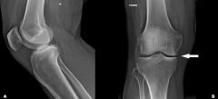 A 35-year-old construction worker presents with medial-sided knee pain. He has no instability complaints but at age 18, he sustained a Grade 1 PCL injury that was treated non-operatively. A radiograph is shown in Figure A. What surgical treatment ...