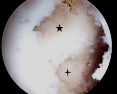 Figure A is an arthroscopic image of a left knee as viewed from an anterolateral viewing portal demonstrating the attachment footprint of a damaged structure. Strengthening of what muscle group most effectively counteracts the deficit that results...