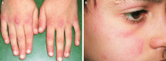 Dermatomyositis Skin features