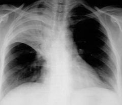 Presence of bronchogram in pneumonia