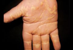 Palmar xanthoma


remnant hyperlipidaemiamay less commonly be seen in familial hypercholesterolaemia