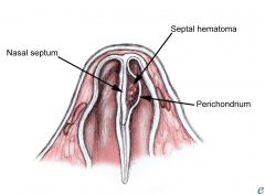 Cartilage running along the midline of the nasal cavity that divides the left and right airways