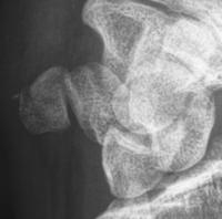 1-Based on clinical history and imaging shown, this patient has developed a pisiform fracture nonunion. Treatment of symptomatic nonunions of the pisiform is by pisiformectomy.
Incorrect Answers
Answer 1: The scapholunate ligament is not affecte...