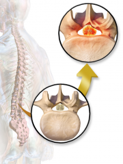 Spinal stenosis is a narrowing of the open spaces within your spine, which can put pressure on your spinal cord and the nerves that travel through the spine to your arms and legs. Spinal stenosis occurs most often in the lower back and the neck.