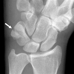 1-pisiform is a sesamoid bone located within the FCU
2-distal radius, hamate, or triquetral fractures
3-pisiform
4-pisiform
5-lat w/30 deg of wrist supination OR utilizing the carpal tunnel view