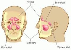 A. Sphenoid sinus
B. Frontal sinus
C. Ethmoid sinus
D. Maxillary sinus