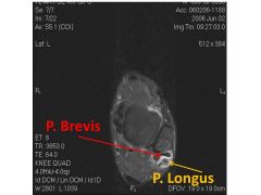 The images demonstrate a peroneus longus tear and the most appropriate treatment is peroneus longus repair of the options provided. Peroneus longus tears occur less frequently than peroneus brevis tears and are related to direct trauma or sports i...