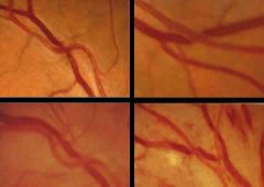 Gunn: Compresión, afilamiento y ocultamiento de la venaSalus: cambio de dirección de la vena
Esclerosis vascular. Retinopatía hipertensiva

