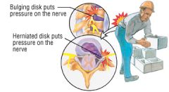 Extruded or herniated nucleus pulposus irritates dural membranes

*About 75%-90% of the population is affected at some time