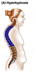 -excessive thoracic kyphosis (hump-back)
-result of erosion or compression fracture of the anterior part of vertebrae
-dowager hump in osteoporosis