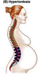 -excessive lumbar and or cervical lordosis
-characterized by an anterior rotation of vertebral column resulting in a rib hump during flexion of trunk