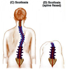 -crooked or curved back
-lateral bending and rotation of vertebral column
-may be postural due to posture (reversible); or structural- due to anomalous vertebrae, differential length of the lower extremities