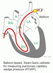 A way of measuring left atrial pressure by inserting a balloon through the RA -> RV -> PA until it reaches a smaller vessel. When the balloon is inflated the pressure on the distal side of the balloon will reach a pressure very similar to that in ...