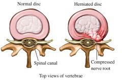 A herniated disc is a condition in which the annulus fibrosus (outer portion) of the vertebral disc is torn, enabling the nucleus (inner portion) to herniate or extrude through the fibers. 