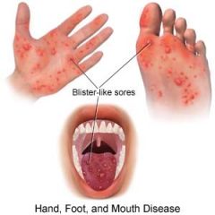 

Hand, foot and mouth disease fxs
