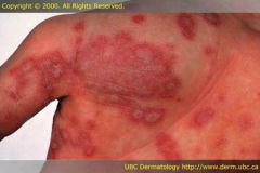 Celecoxib (sulfonamide) can cause exfoliative dermatitis (SJS steven johnson syndrome) and toxic epidermal necrolysis (TEN) which could be fatal.

Celecoxibs have more tendency than other drugs to have this allergy

Allergies to sulfa drugs ca...