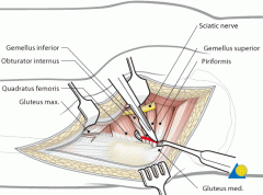 3(1) "incise" through subcutaneous fat(2)incise fascia lata in lower half of incision(3)split gluteus maximus muscle along avascular plane(4)release portion of gluteal sling to aide in anterior retraction of muscle belly(5)detach short external ro...