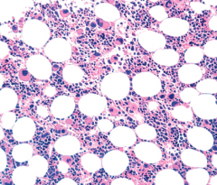 Agranulocytosis