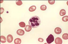Megalobastic Anemia