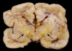 What causes the basal ganglia to be yellow?