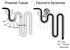 Fanconi Syndrome