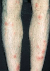 What condition is this?
Why does it occur?
What symptoms are associated with it?
What systemic disease is it ass. with?
Tx?