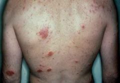 Nummular Eczema (associated with irritants)