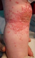 Eczema Herpeticum (due to HSV)