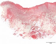 Hvilke typer av vev er inkludert i snittet?

Hvilke vev er involvert i den patologiske prosessen?
