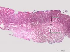 Cøliaki

Mucosa mangler tarmtotter (= flat og ombygget tarm)

Submukøse kjertler