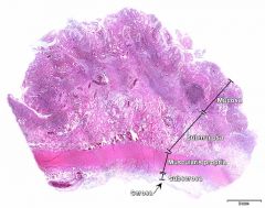 Ulcerøs colitt

Mucosa og øvre del av submucosa er patologisk forandret.

Polypp = Struktur som hever seg over slimhinnenivå.

Pseudopolypp ser ut som en polypp fordi slimhinnen omkring er borte på grunn av sårdannelse.