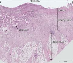 Adenocarsinom i ventrikkel

Ulcus (sår) = Tap av slimhinne, dypere enn muscularis mucosae