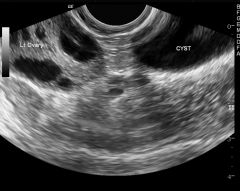 **cyst SEPERATE from ovary
- complex