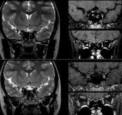 Optic Neuritis
Top Acute
Bottom Resolved
