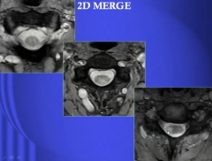 MS Cord
2D MERGE
Look at T2 Also
Axial and Sagittal