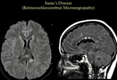 SUSAC
RetinocochleacerebralMicroangiopathy
 
Misdx as MS