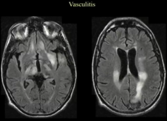 Vasculits
Patchy- But Nonspecific