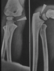 medial epicondylar fracture
Surgery open reduction internal fixation
> 5 mm displacement