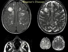 Wegener's Disease
Fulminant
Whtie matter
Enhancement
Nasal Septum Involvement