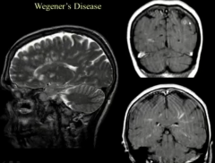 Wegener's Disease
Enhancement Follows Vessels
MS Rounded Enhancement